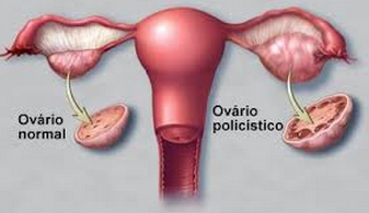 Sindrome do ovário policístico 1