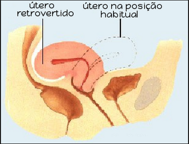 utero retrovertido