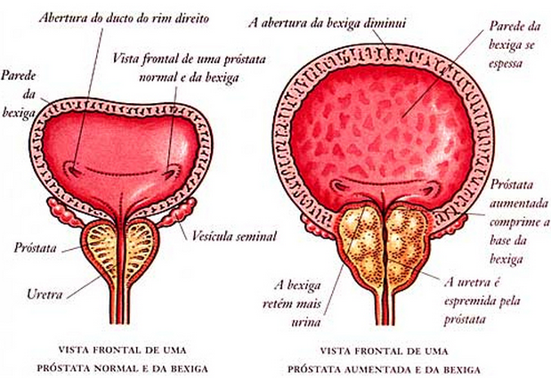 diagnóstico e tratamento câncer de próstata
