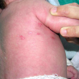 herpes neonatal