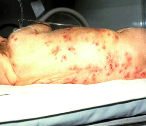 herpes neonatal em bebê